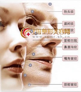 女性用伊维兰除皱安全吗