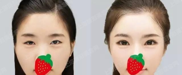 上海美尔雅整形医院赵海波所提出的鼻修复是目前比较新的技术