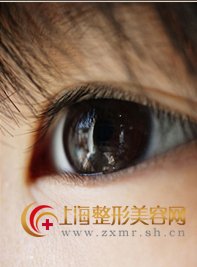 祛眼袋整形,你知道吗