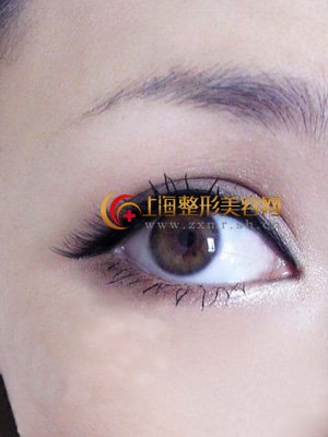 微创祛眼袋手术过程会疼吗