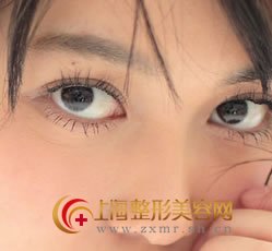 怎么预防和祛除眼袋