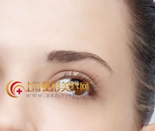 做双眼皮切开好还是埋线好