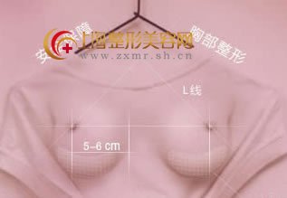 韩式隆胸与其它隆胸有什么区别