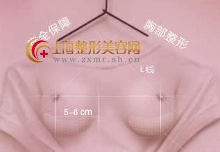 自体脂肪隆胸会留下后遗症吗