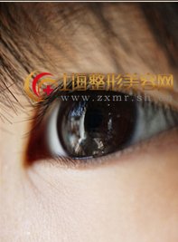 开眼角手术拆线时疼不疼