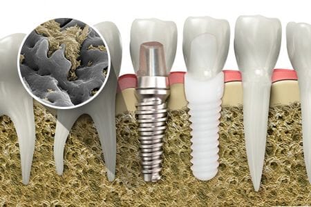 种植牙